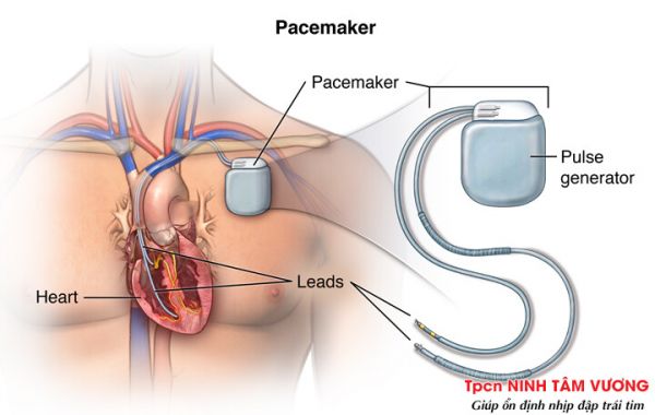 Cảm biến của máy tạo nhịp tim quá mạnh trên điện tâm đồ