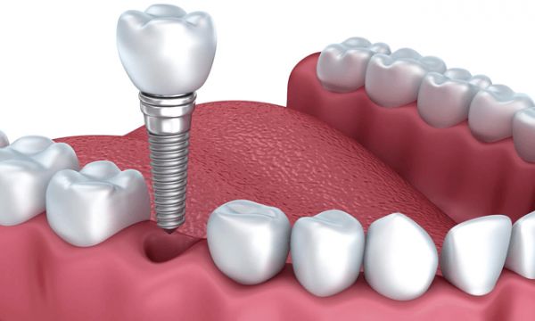 Cấy ghép răng giả và xương nha khoa