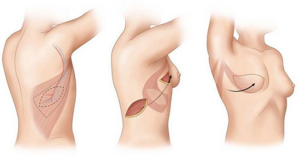 Cấy ghép tái tạo vú