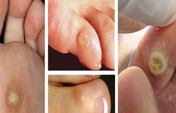 Chỉ số mắt cá chân, cánh tay