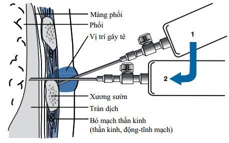 Chọc dò dịch màng phổi: ý nghĩa lâm sàng kết quả thủ thuật