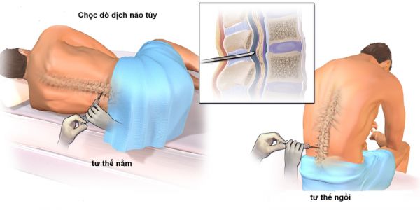 Chọc dò tủy sống: ý nghĩa lâm sàng giá trị kết quả