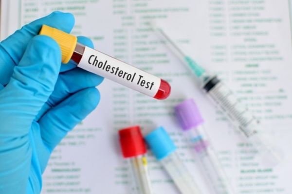 Cholesterol và triglyceride máu: ý nghĩa lâm sàng chỉ số xét nghiệm