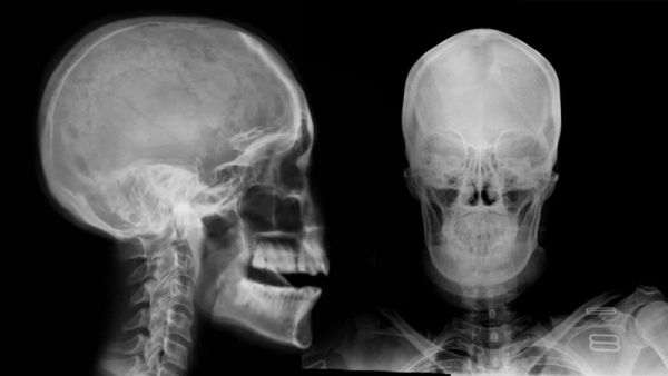 Chụp x quang sọ: ý nghĩa lâm sàng giá trị kết quả