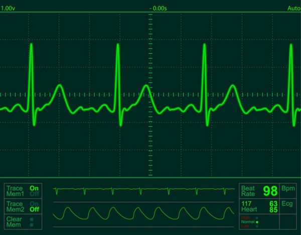 Cử động run cơ tạo hình ảnh điện tâm đồ