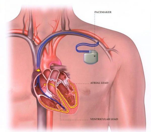 Điện tâm đồ thể hiện nhiễu xuyên âm máy điều hòa nhịp tim