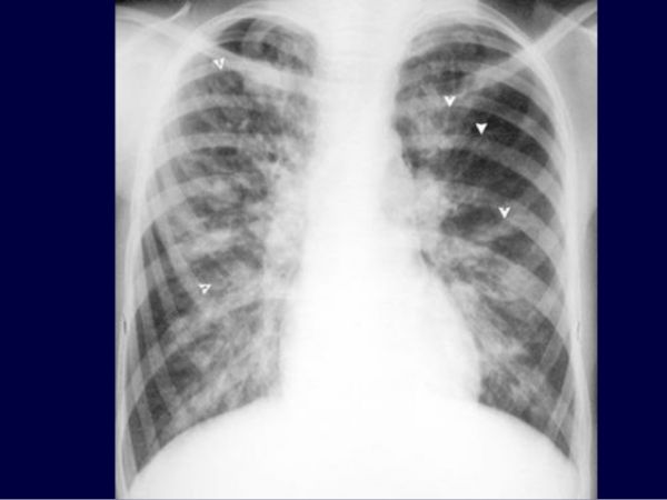 Giãn phế quản dạng ngón tay đi găng