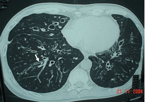 Giãn phế quản phổi phải dạng chùm nho