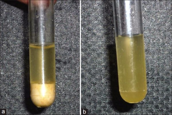 Globulin tủa lạnh: ý nghĩa lâm sàng chỉ số xét nghiệm