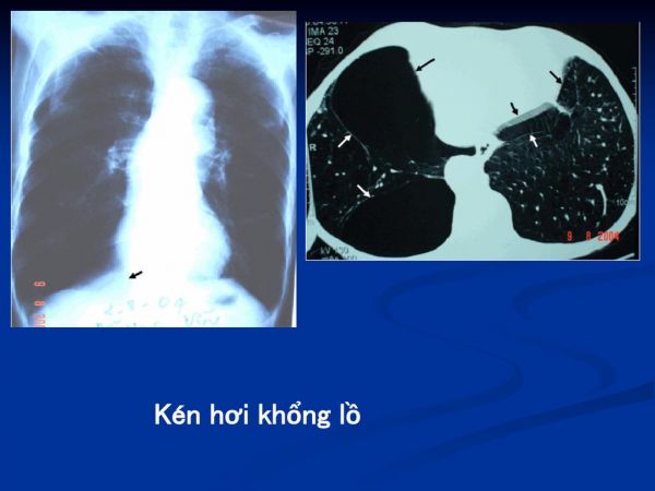 Kén hơi khổng lồ phổi trái