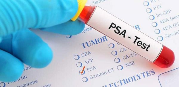 Kháng nguyên đặc hiệu tuyến tiền liệt (PSA): ý nghĩa lâm sàng kết quả xét nghiệm