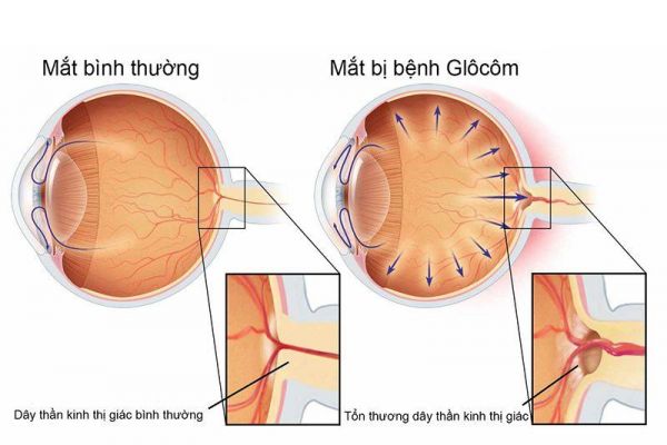 Kiểm tra trường thị giác cho bệnh tăng nhãn áp: ý nghĩa lâm sàng