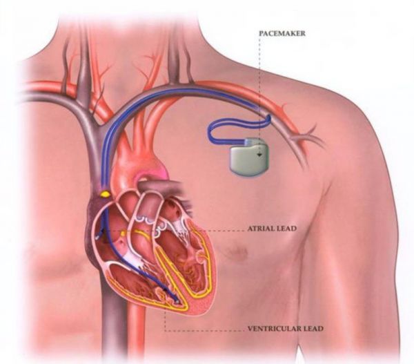 Máy tạo nhịp tim VVI không giữ nhịp do chống máy trên điện tâm đồ