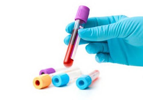 Natri (Na) trong máu: ý nghĩa lâm sàng chỉ số xét nghiệm