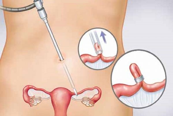 Ngừa thai vĩnh viễn Adiana