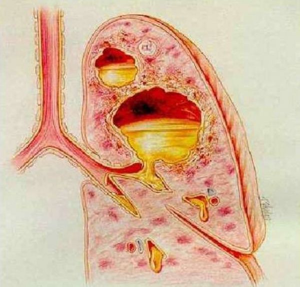 Nhiễm khuẩn gây áp xe phổi