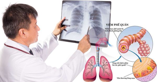 Nhiễm khuẩn gây viêm phế quản phổi