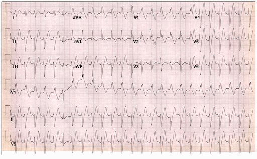 Nhịp tim nhanh thất tự phát đa hình từ hệ thống dẫn truyền mạng Purkinje thất trái