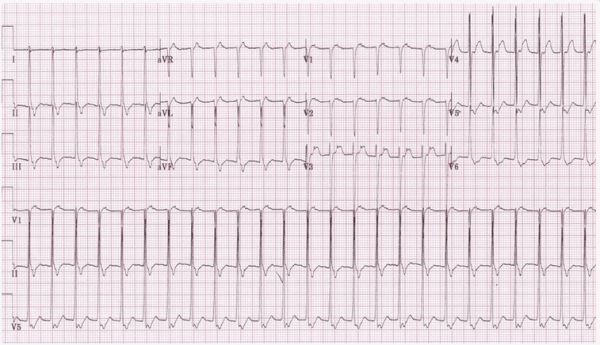 Nhịp tim nhanh vào lại nhĩ thất (AVRT) và kịch phát trên thất (PSVT)