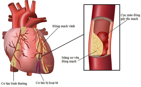 Nhồi máu cơ tim bán cấp vùng thành trước: hình ảnh điện tâm đồ và hướng xử trí
