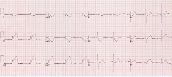 Nhồi máu cơ tim cũ: hình ảnh trên điện tâm đồ