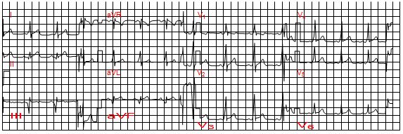 Nhồi máu cơ tim vùng sau dưới tiến triển trên điện tâm đồ