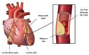 Nhồi máu cơ tim vùng trước vách trong sự hiện diện của block nhánh phải