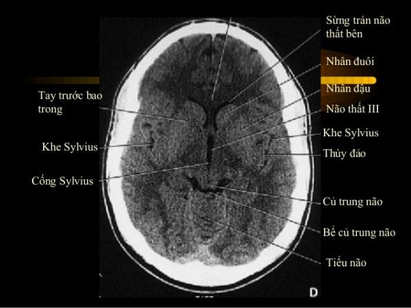 Nhồi máu tiểu não