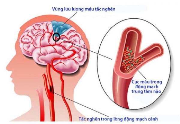 Nhũn não động mạch não sau