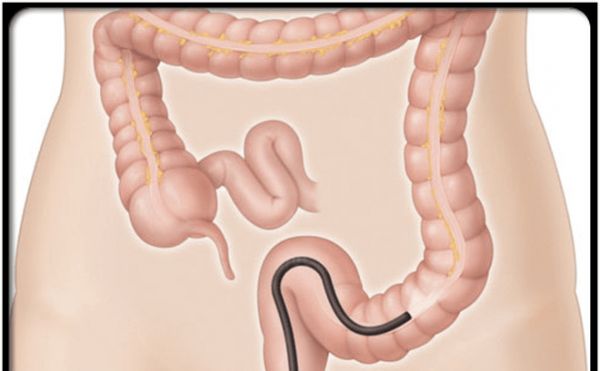 Nội soi đại tràng: ý nghĩa lâm sàng giá trị kết quả