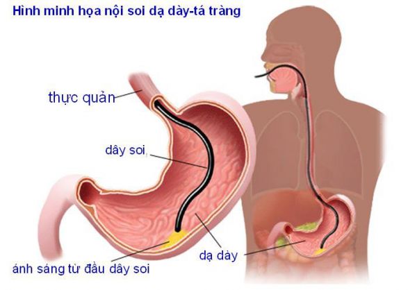 Nội soi đường tiêu hóa trên: ý nghĩa lâm sàng giá trị kết quả