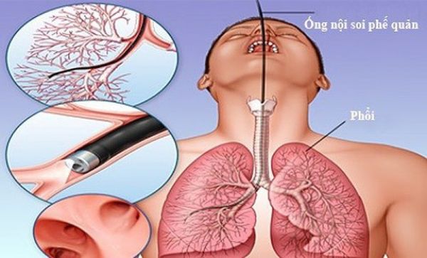 Nội soi phế quản: ý nghĩa lâm sàng giá trị kết quả