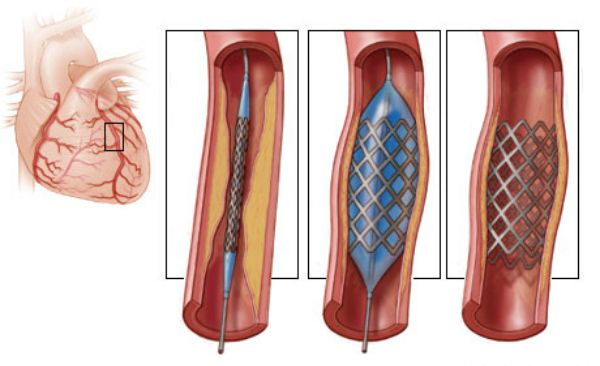 Nong mạch vành và ống đỡ động mạch (stent)