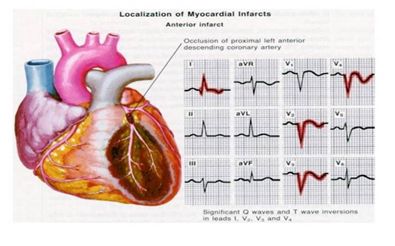 Phì đại tâm thất trái giả nhồi máu cơ tim vùng trước vách trên điện tâm đồ