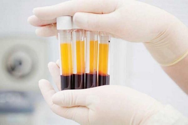 Protein huyết thanh: ý nghĩa lâm sàng chỉ số xét nghiệm