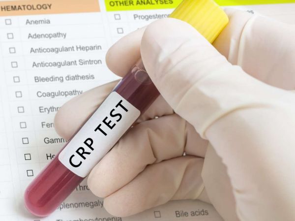 Protein phản ứng C (CRP): ý nghĩa lâm sàng chỉ số xét nghiệm