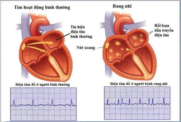 Rung nhĩ điển hình ngược chiều kim đồng trên điện tâm đồ