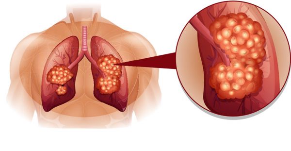 Sàng lọc ung thư phổi: CT scan liều thấp
