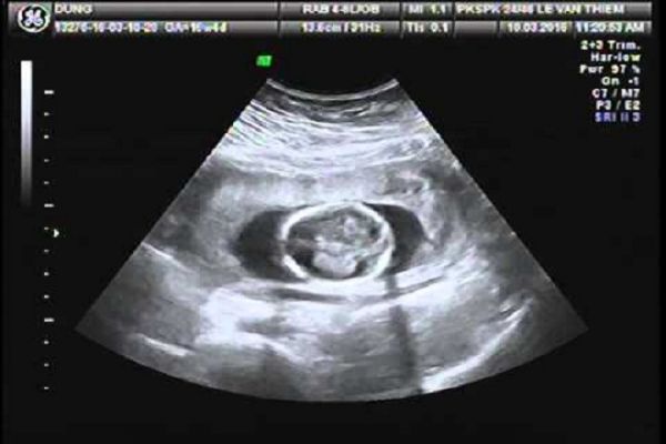 Siêu âm thai nhi
