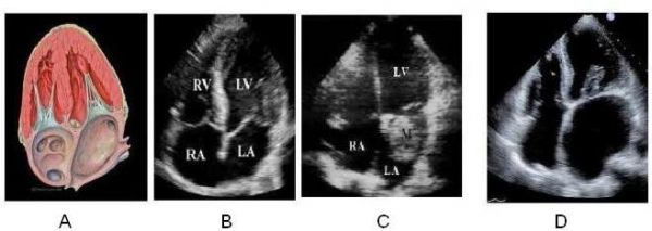 Siêu âm tim (Echocardiograms)