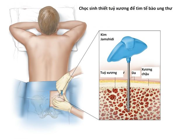 Sinh thiết tủy xương và hút tủy