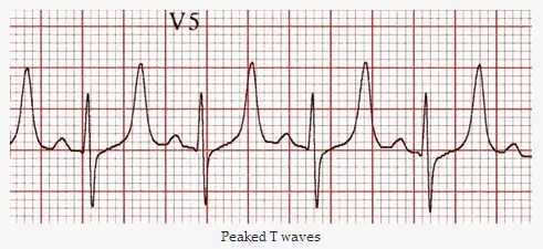 Tăng kali máu trên điện tâm đồ