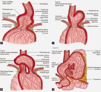Thoát vị hoành bên phải có mức nước mức hơi