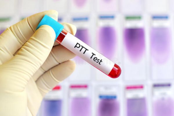 Thời gian thromboplastin từng phần (PTT): ý nghĩa lâm sàng chỉ số xét nghiệm
