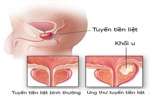 Tia bức xạ bên ngoài đối với ung thư tuyến tiền liệt