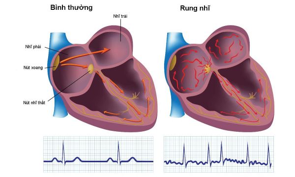 Tiền kích thích với rung nhĩ trên điện tâm đồ