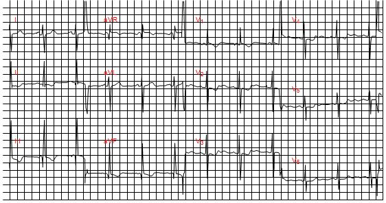 Trục điện tim lệch phải ở bệnh nhân thông liên nhĩ lỗ thứ hai