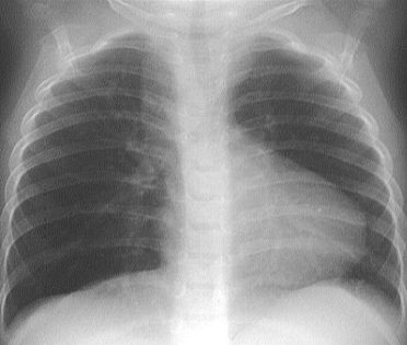 Tứ chứng Fallot trên x quang