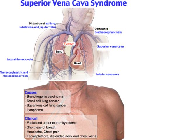 U phổi chèn ép tĩnh mạch chủ trên