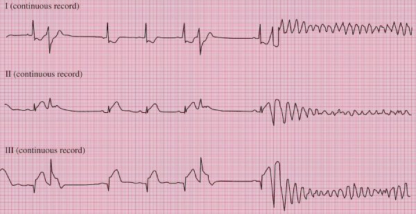 Verapamil nhạy cảm với nhịp nhanh thất trên điện tâm đồ